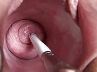 Vinam - Cervix penetration