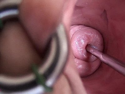 Vinam - Cervix penetration